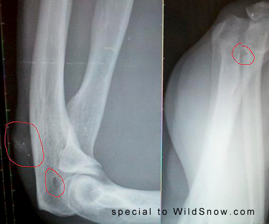 Backcountry skiing binding injury. Backcountry skiing binding injury.
