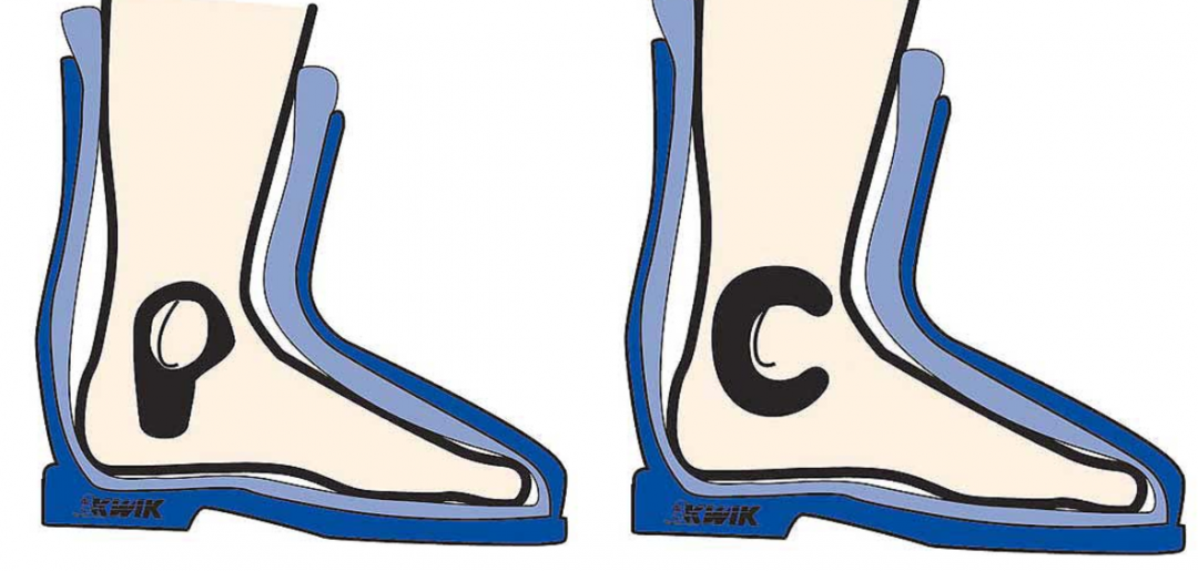 Pads as offered by SVST.com are a great option for alleviating bone pain before the problem comes chronic.
