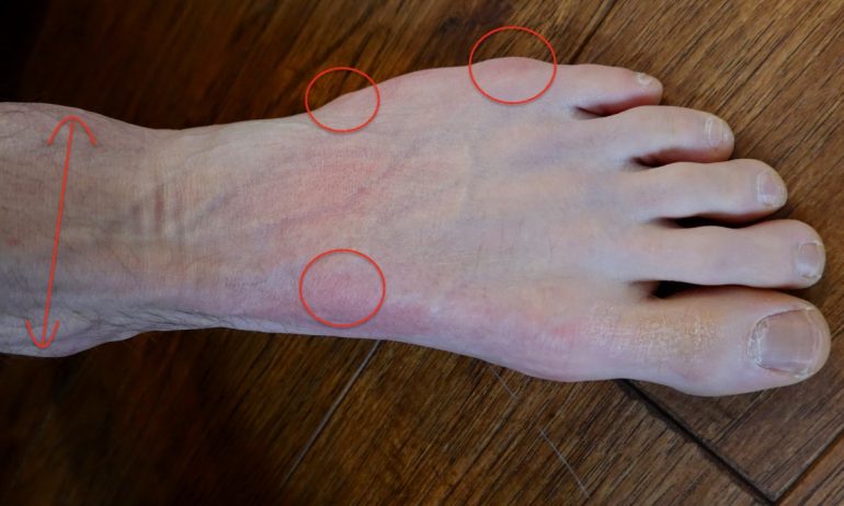 My problem spots are plenty but not uncommon: Navicular, both ends of the 5th metatarsal, and both malleoli. I will punch for one or more of these within the first few weeks, pad for the others.
