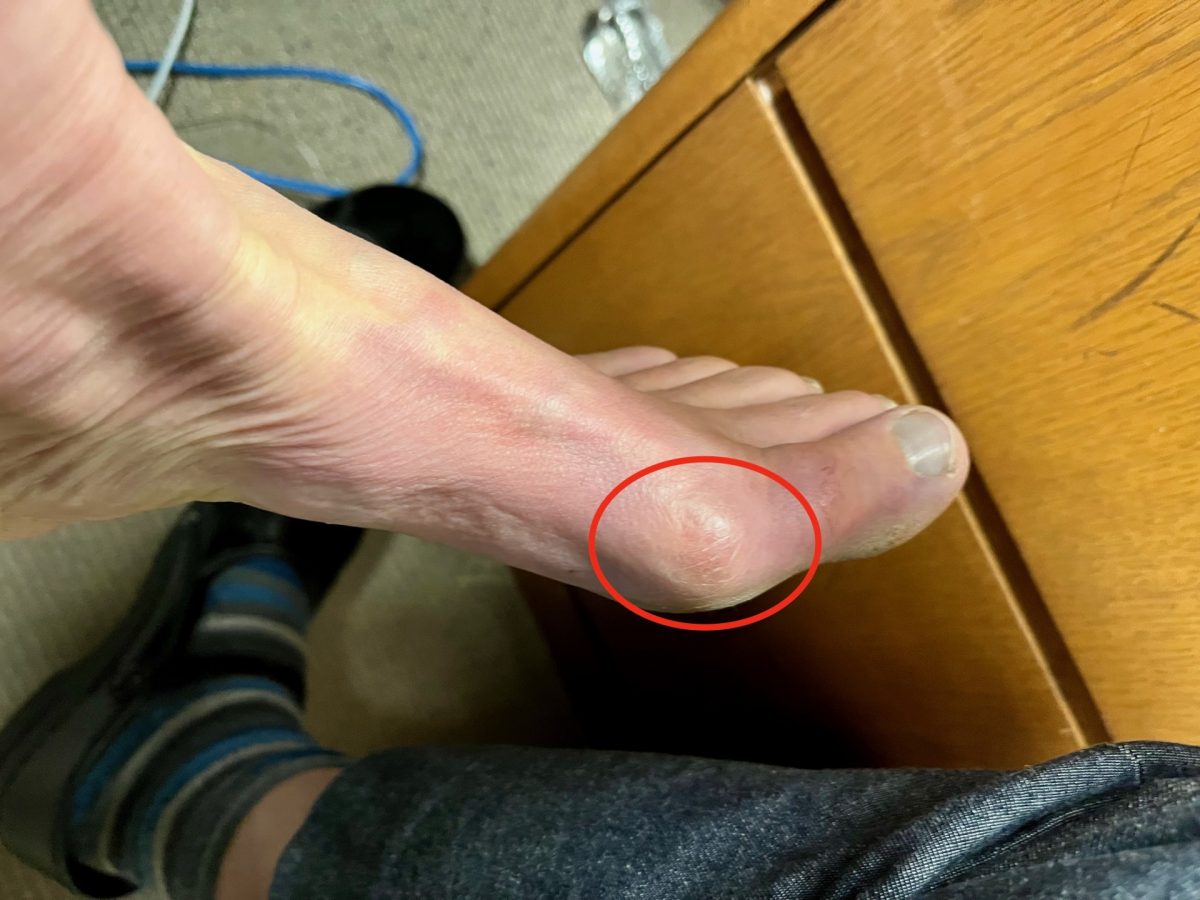 Bunion-1